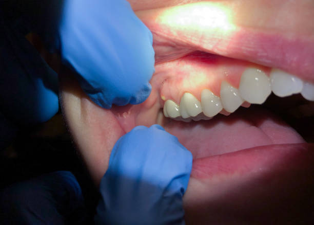 Best Broken Tooth Emergency  in Bronson, FL